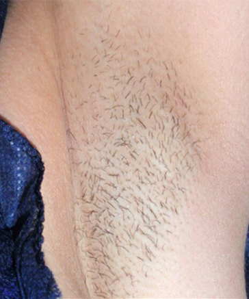 Before-Vectus-2